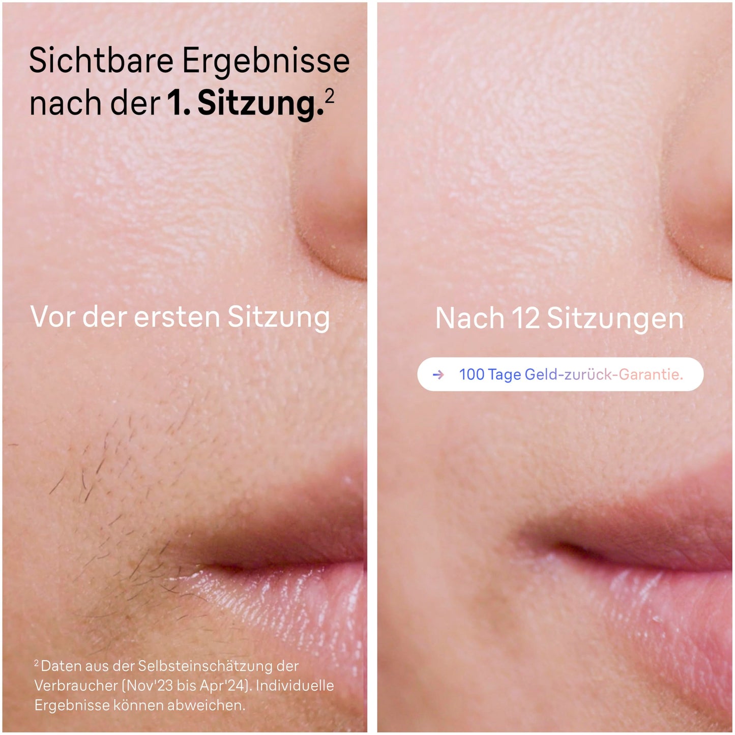 Braun Smart IPL 7 Skin i·expert – IPL Haarentfernungsgerät, Dauerhafte und Schmerzfreie Haarentfernung für Zuhause – inkl. Gratis App, Etui, Venus Rasierer, 3 smarte Aufsätze – PL7253, Weiß/Rosegold